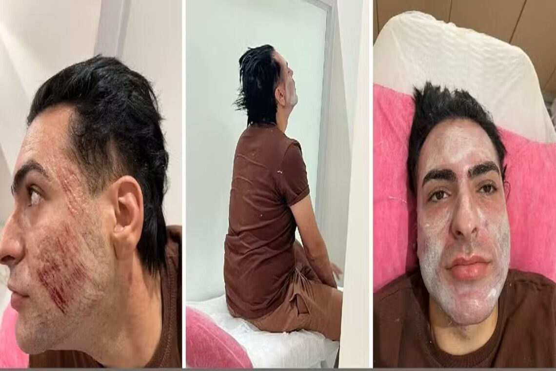 Empresário morreu após inalar fenol em procedimento de peeling, mostra laudo - 