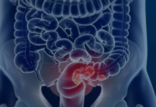 Mais de 60% dos casos de câncer colorretal no Brasil são diagnosticados tardiamente, aponta estudo - 