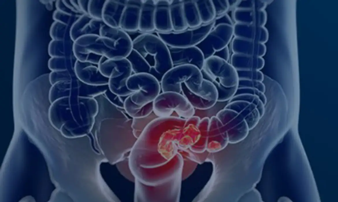 Mais de 60% dos casos de câncer colorretal no Brasil são diagnosticados tardiamente, aponta estudo - 